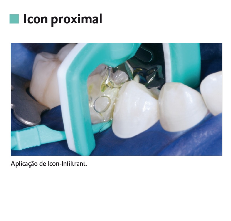 Infográfico do produto Removedor de Manchas Proximal Icon Approximal - 2 Unid. Infográfico do produto Removedor de Manchas Proximal Icon Approximal - 2 Unid.